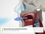 FaceFormer im Einsatz: Nasenatmung wiederherstellen